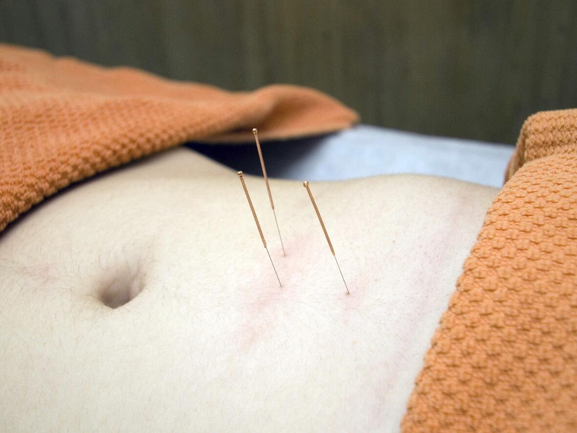 acupuncture-4175624_1920